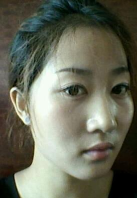 鞍山菲之都整形醫(yī)生李宗亮做字體脂肪豐太陽穴效果怎么樣？附案例效果對比圖