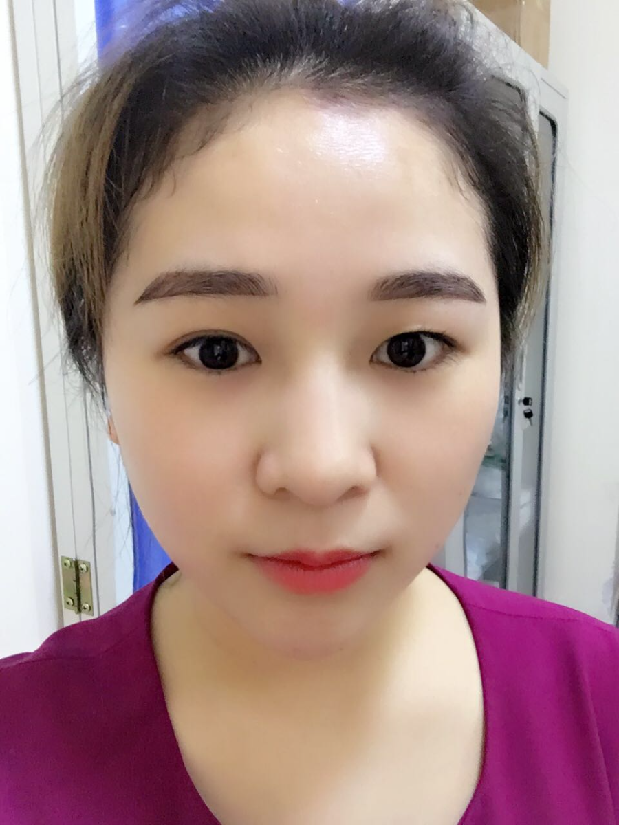 蚌埠韓美美萊整形醫(yī)生鄭捷做開眼角怎么樣？附案例效果圖