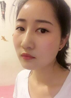 鞍山菲之都整形醫(yī)生李宗亮做字體脂肪豐太陽穴效果怎么樣？附案例效果對比圖