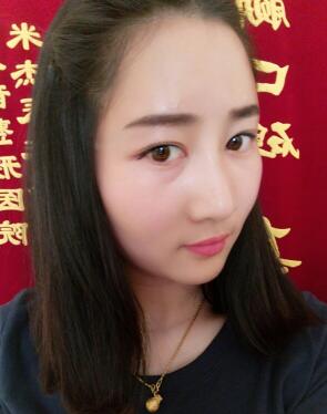 鞍山菲之都整形醫(yī)生李宗亮做字體脂肪豐太陽穴效果怎么樣？附案例效果對(duì)比圖