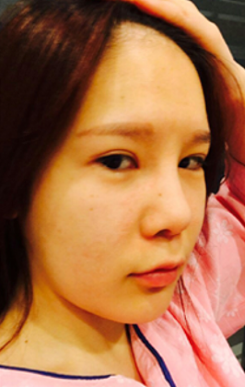 安康希顏醫(yī)療整形醫(yī)生王奇效做面部吸脂怎么樣？附案例效果對比圖