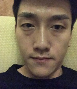 鞍山燕麗醫(yī)療美容醫(yī)院薛媚醫(yī)生做去眼袋效果怎么樣？附案例效果對比圖