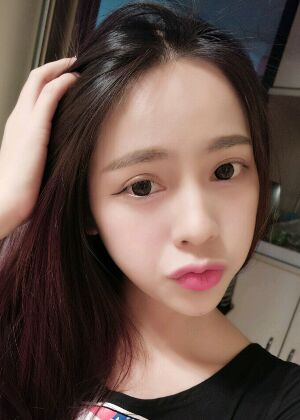 鞍山王景醫(yī)療美容外科診所做自體脂肪豐蘋果肌效果怎么樣？附張婉鸝案例效果圖