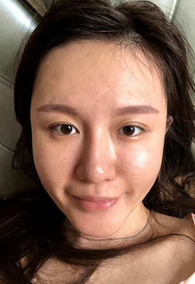 蚌埠韓美美萊整形醫(yī)生張燕做自體脂肪豐面頰效果怎么樣？附案例效果圖