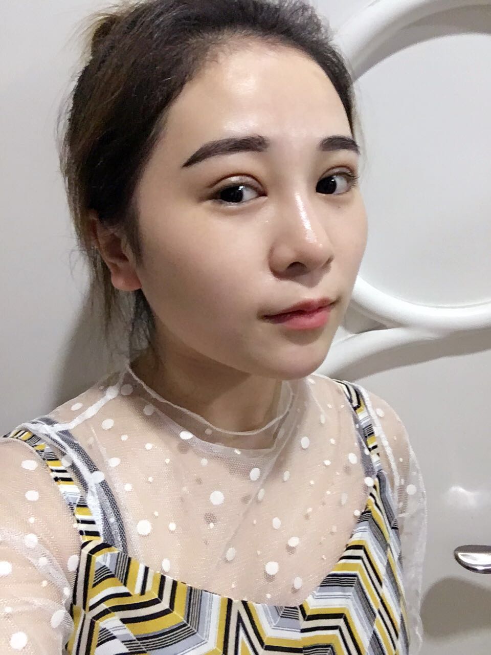 蚌埠韓美美萊整形醫(yī)生鄭捷做開眼角怎么樣？附案例效果圖