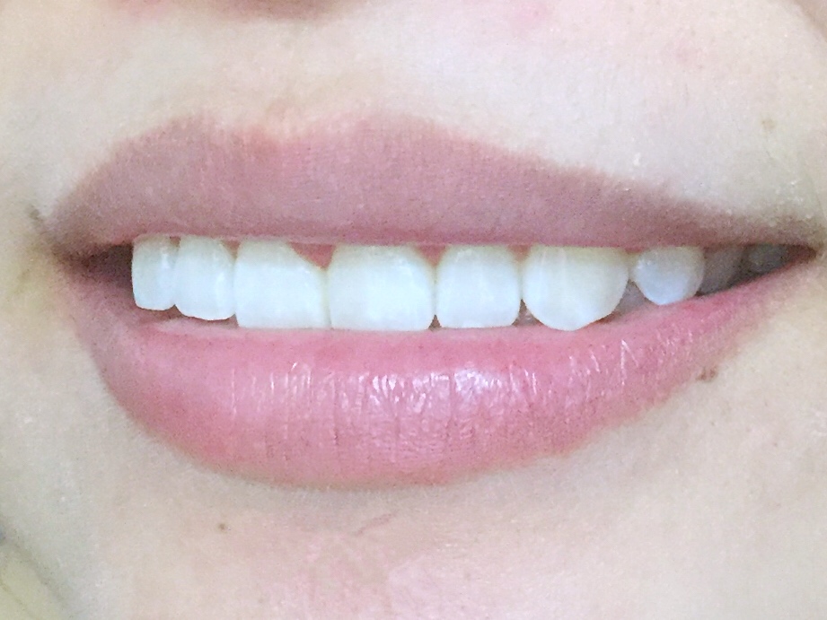 安慶渡江口腔醫(yī)院張良斌醫(yī)生做超聲波洗牙效果怎么樣？附洗牙案例效果圖