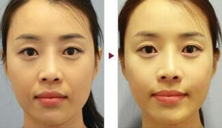 保定安卓貝拉做注射去法令紋怎么樣？附儲(chǔ)君醫(yī)生法令紋案例效果圖