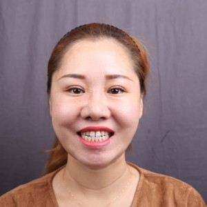 保定東陽口腔醫(yī)院趙晨醫(yī)生做瓷貼面怎么樣？附瓷貼面案例效果對(duì)比圖