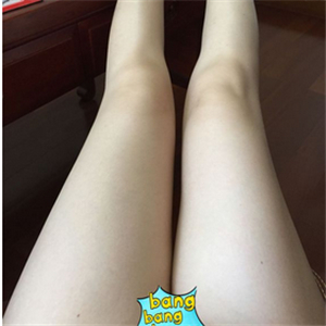 保定市第五醫(yī)院美容整形科做大腿吸脂怎么樣？附劉根立醫(yī)生案例效果圖