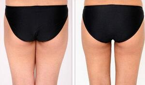 蚌埠市第三人民醫(yī)院燒傷整形科徐衛(wèi)東醫(yī)生做臀部吸脂效果怎么樣？