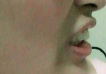 保定東陽口腔醫(yī)院馮春城醫(yī)生做烤瓷牙怎么樣？附烤瓷牙案例效果對(duì)比圖