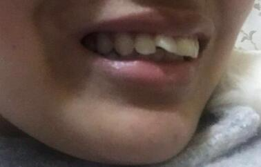 保定東陽口腔醫(yī)院馮春城醫(yī)生做烤瓷牙怎么樣？附烤瓷牙案例效果對(duì)比圖