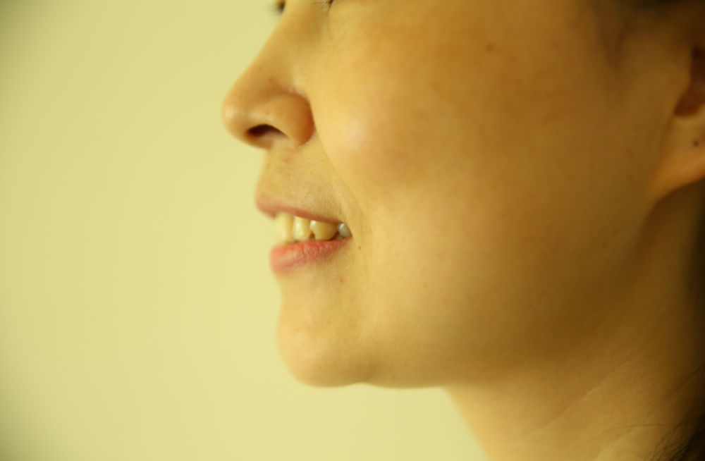 保定東陽口腔醫(yī)院趙星醫(yī)生做牙齒瓷貼面怎么樣？附牙齒瓷貼面案例效果對(duì)比圖