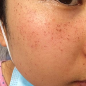 寶雞皮膚病醫(yī)院文東亮醫(yī)生做臉部祛斑效果怎么樣？附臉部祛斑案例