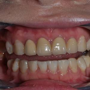 保定東陽口腔醫(yī)院張亞靜醫(yī)生做牙齒冷光美白怎么樣？附冷光美白案例效果對(duì)比圖