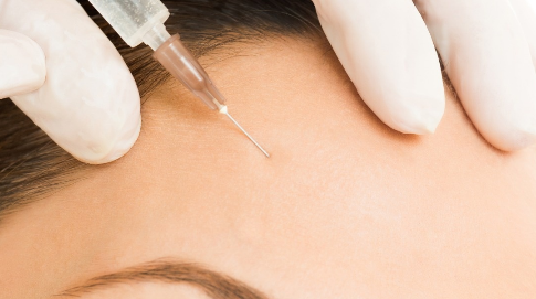 注射法令紋大概多少錢？