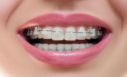 貴金屬烤瓷牙是什么？價格大概是多少？