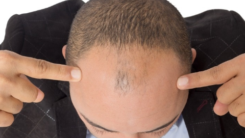 頭發(fā)可以種植嗎？頭發(fā)種植一般需要多少錢？