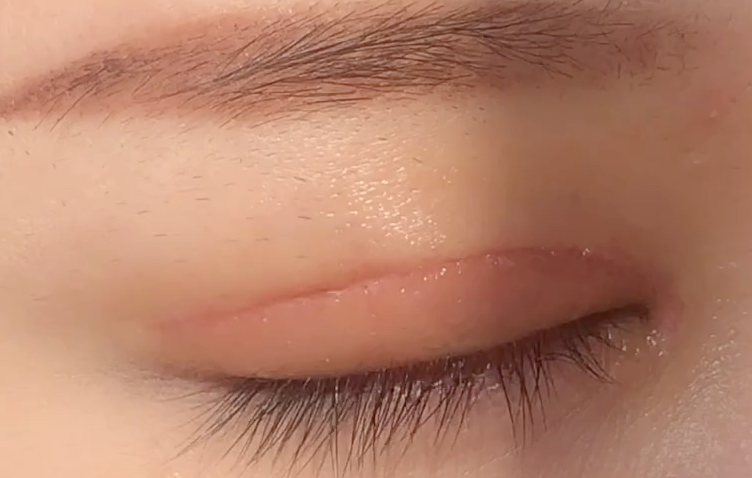 全切雙眼皮多久恢復？全切開雙眼皮有哪些優(yōu)點？
