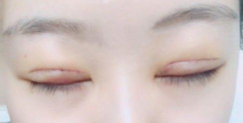 做全切雙眼皮能維持多久？全切雙眼皮多長時(shí)間能恢復(fù)？