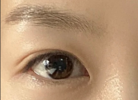 全切雙眼皮效果怎么樣？全切雙眼皮多久自然？