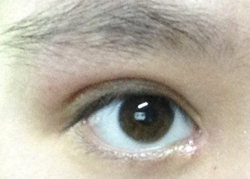 韓式開眼角的效果怎么樣？韓式開眼角失敗了怎么辦？