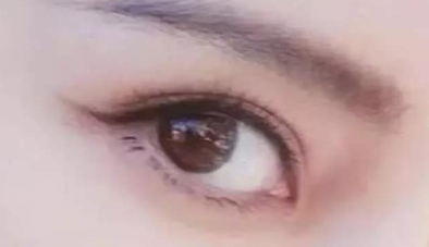 開眼角多久可以完全恢復？開眼角多少費用？