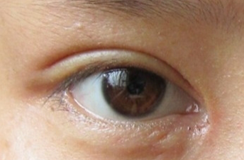 開眼角手術(shù)會(huì)不會(huì)留疤？開眼角手術(shù)后應(yīng)該注意什么？