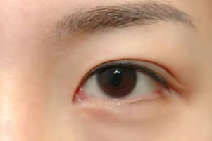 光纖溶脂祛眼袋有效果嗎？