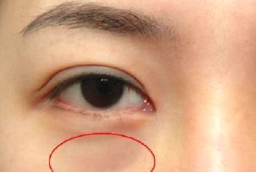 光纖溶脂祛眼袋需要多少錢(qián)？光纖溶脂怎么樣呢？