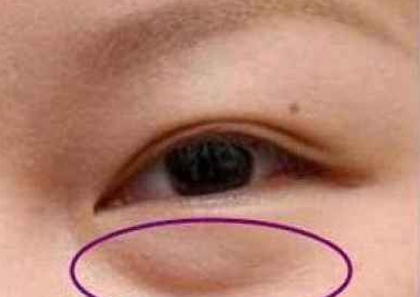 激光去眼袋有什么好處？激光祛眼袋有用嗎？