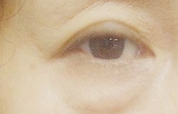 激光祛眼袋能維持多長時(shí)間？