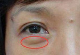 激光去眼袋可以管多久？激光祛眼袋多久可以恢復？