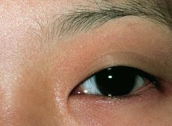 激光祛眼袋可靠嗎？激光去眼袋會不會留疤？