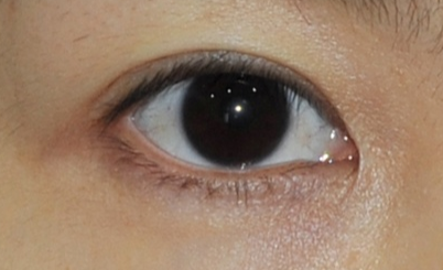 遵義韓美整形醫(yī)院開眼角怎么樣？開眼角的價(jià)格是多少？