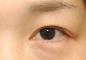 激光去眼袋術(shù)后會不會反彈？激光去眼袋術(shù)后注意事項(xiàng)？