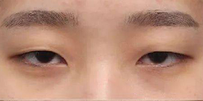 內(nèi)眥贅皮矯正術前