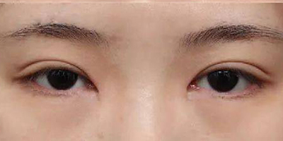 內(nèi)眥贅皮矯正術后