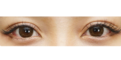 切開雙眼皮術(shù)后