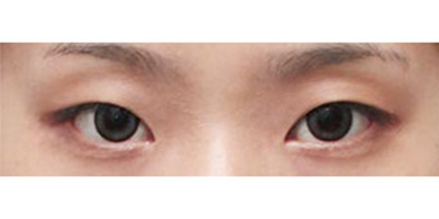 下瞼下至術(shù)術(shù)前