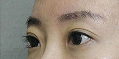 玻尿酸豐眉弓術(shù)前