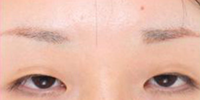 假體墊眉弓術(shù)前