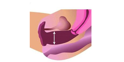 私密超聲提升術(shù)前