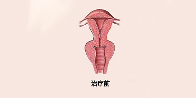 手術緊縮陰道術前