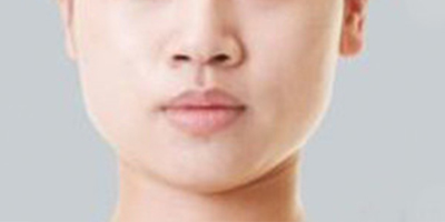 下頜角整形術(shù)前