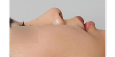 玻尿酸隆鼻術后