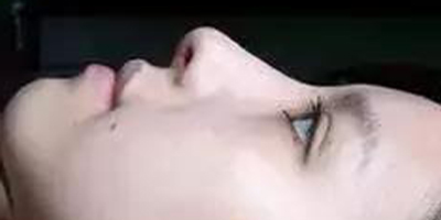 自體軟骨墊鼻尖術(shù)后