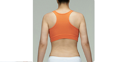 冷凍溶脂瘦背部術(shù)后