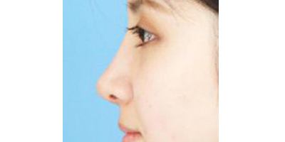 鼻部多項術(shù)后