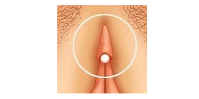 陰蒂整形術(shù)術(shù)后